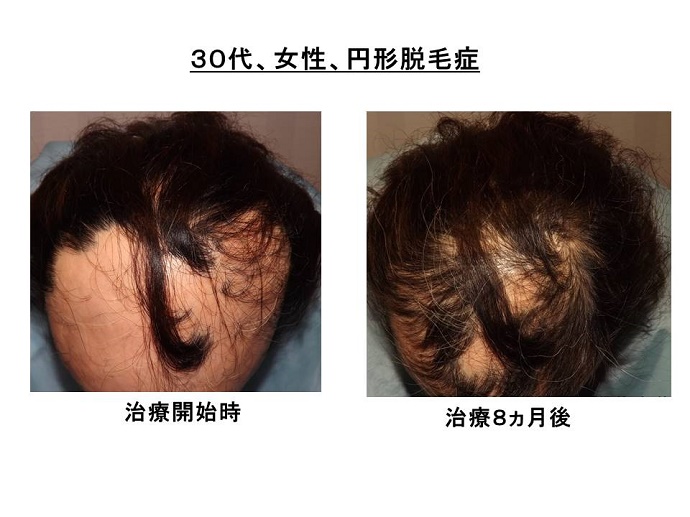 円形脱毛症　病院""